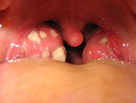 280px-tonsillitis